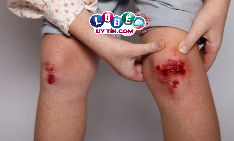 Điềm báo mơ thấy chảy máu chân đánh con gì? Có ý nghĩa gì?