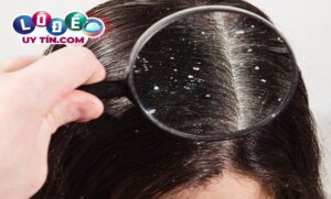 Giải mã giấc mơ thấy đầu có chấy - Số nào may mắn?